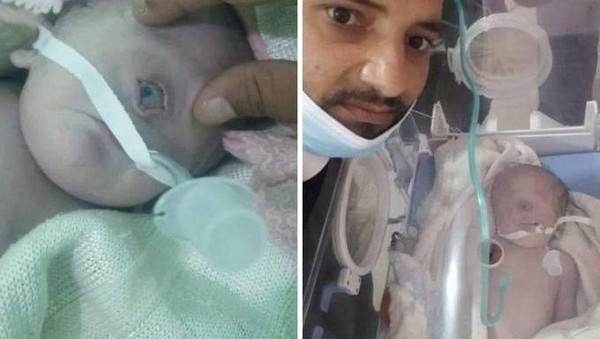 Viral Bayi Bermata Satu Lahir di Yaman, Ini Kemungkinan Penyebabnya